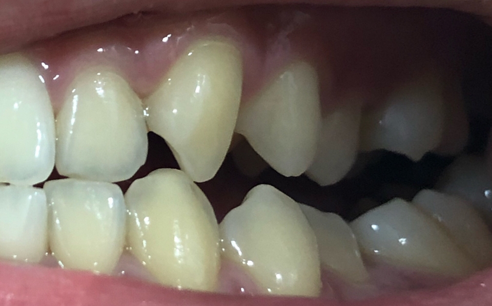 검정색이다보니 쿨 할 것 같아서 민트맛이 강할 줄 알았는데 다른 치약보다 시원함이 덜 하고, 시원함도 덜 오래가요 뭔가 마일드한 느낌의 치약인 것 같아요 칫솔모가 부드럽고 길어서 구석구석 닦이는 느낌이었어요 그리고 칫솔 몸통이 납작하고 넓다보니 왼쪽 어금니 닦고 오른쪽 어금니 닦으러 넘어가면서 치아에 딱딱 부딪히는 게 불편했어요