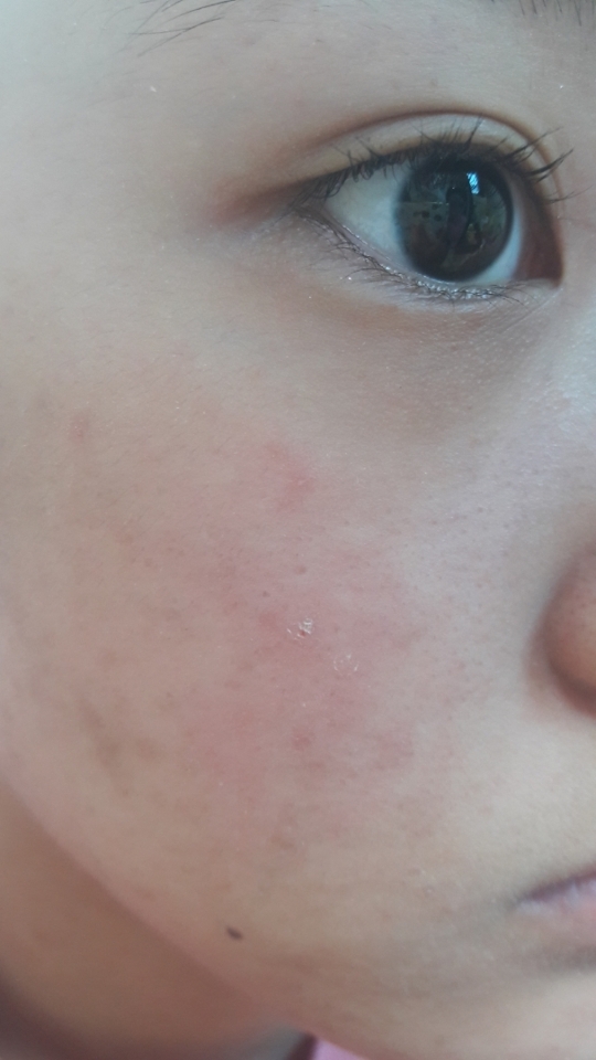 요즘 날씨도 습한데 왜이리 피브가 뜨는지... 건성 그 자체입니다 특히 볼과 입술쪽 말이죠....ㅠ