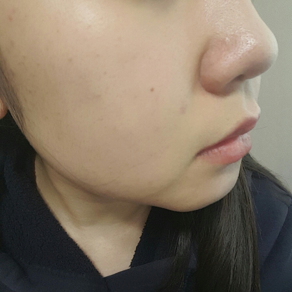 안 바른쪽 입니다
보시면 거뭇거뭇하고 트러블자국도있고 말이아니죠ㅠㅠ