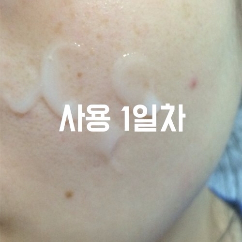 2-3일차 사진이 없은데.. 암튼 이때쯤 큰 변화를 못느끼다가 3일차부터 갑자기 뾰루지인지 여드름인지 하나둘씩 났어요ㅜ 일단 바르는거 중단했고 메이크업할따는 여전히 화장히 밀리고 들뜨는 현상..