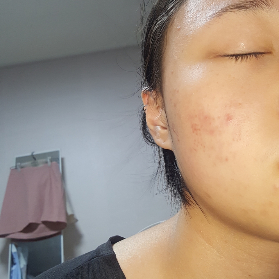 지금보다 더 더러운 피부상태... 