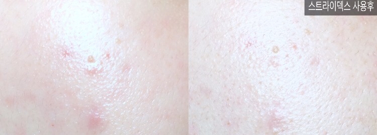이 사진은 사용한 지 1일째 되던 때였어요!
붉은기와 트러블이 잠잠~해져서 이때부터 큰 기대를
하고 더 열심히 ㅋㅋㅋ 하루에 2매씩 사용하기 시작했
었죠 ㅎㅎㅎ 저만큼 민감한 친구도 쓰던 제품이었기에
좀 더 믿고 사용했던 것도 있었어요