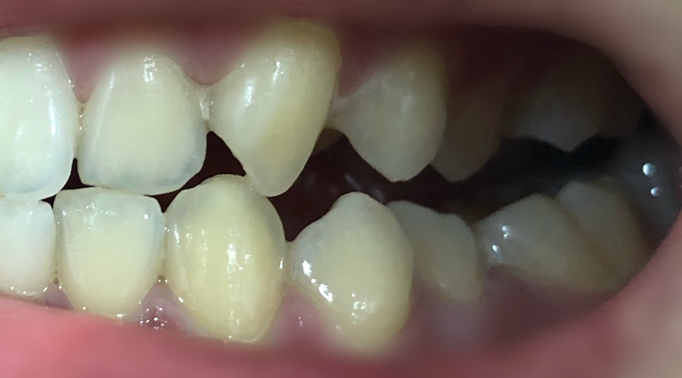 치약이 평소 쓰던 것보다 조금 쓴 맛이 나고 거품이 잘 나서 좋았어요 검정색 치약이다보니 거품도 연한 회색인데 그렇다고 치아가 검정색으로 변하지도 않았고, 풍성한 거품이 아니라 물 같은 물거품?이다보니 양치 도중 찍은 사진인데도 거품이 거의 없네요