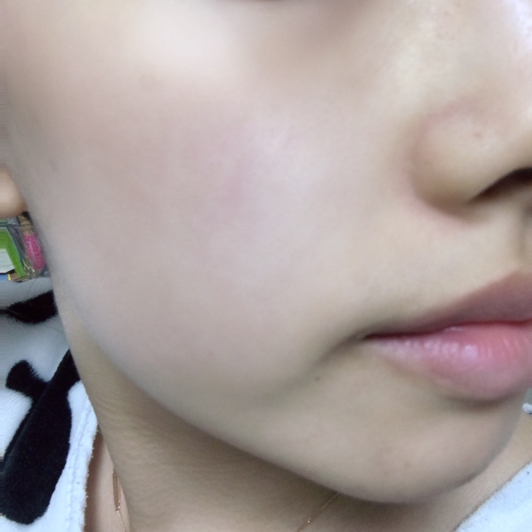 세안 후 아무것도 바르지 않은 상태입니다