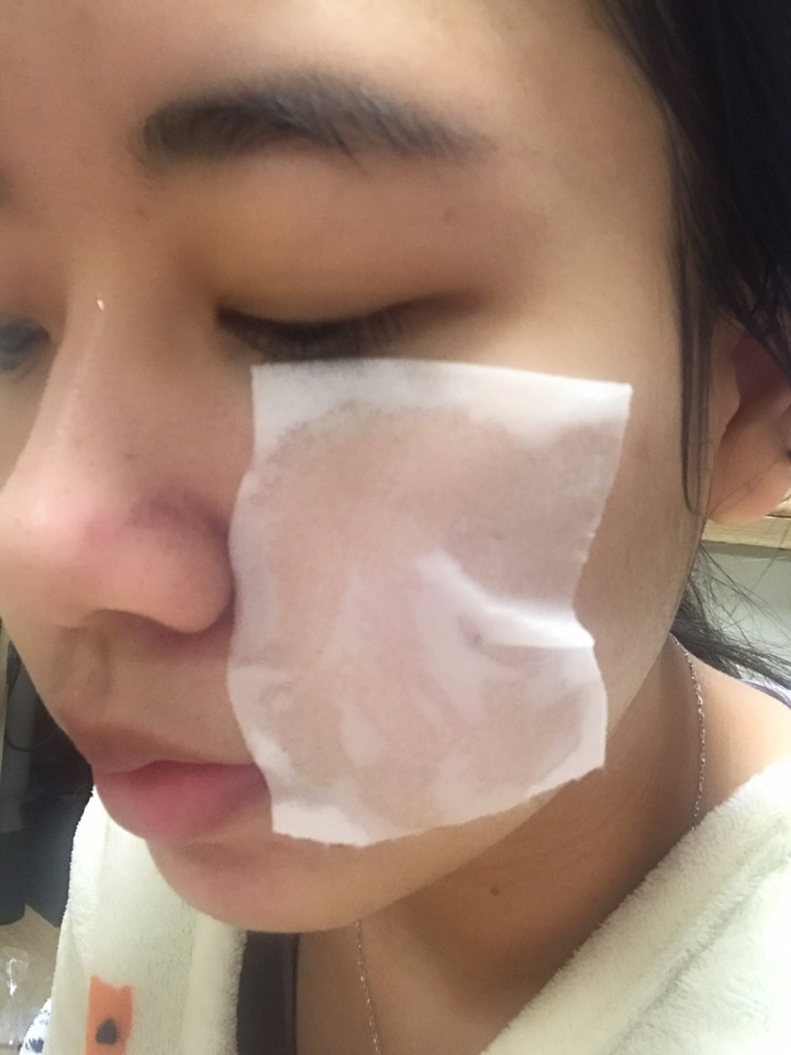 독도토너는 콧물제형이 아닌 그냥 찰랑찰랑한 물 토너에요!
일단 독도토너를 화장솜에 적셔서 팩을 해주었어요! 사진으로는 볼만 붙였는데 사진찍은 후에는 이마,턱,코까지 해봤습니다
5분정도 지난 후에 다 떼어내고 여분의 토너로 얼굴을 한번 싹 닦아내주었어요!