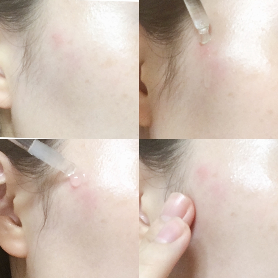  마지막 단계에선, 사실 응급스팟만 사용해줘도 충분해요. 근데 저는 부분적으로 트러블 부위에 바이애콤의 퓨어카밍 앰플을 발라 흡수시켜준 뒤, 응급스팟을 발라줬어요! 

 응급스팟은 약간 젤 텍스처에 가까워요. 트러블 케어 제품임에도 불구하고 바른 후, 피부를 화하게 만들거나 따가움을 유발하지 않아요. 약간 바를때 약간이 시원함만 전달해주는 정도??

바르고 좀 시간이 경과하면, 얇은 스팟 패치를 붙인 것처럼 이 부위에 얇은 막이 생겨요! 굳이 트러블 패치를 붙일 필요없이 자극받은 부위가 보호되기 때문에 아이소이 제품을 사용해봤어요 ㅅㅁㅅ
