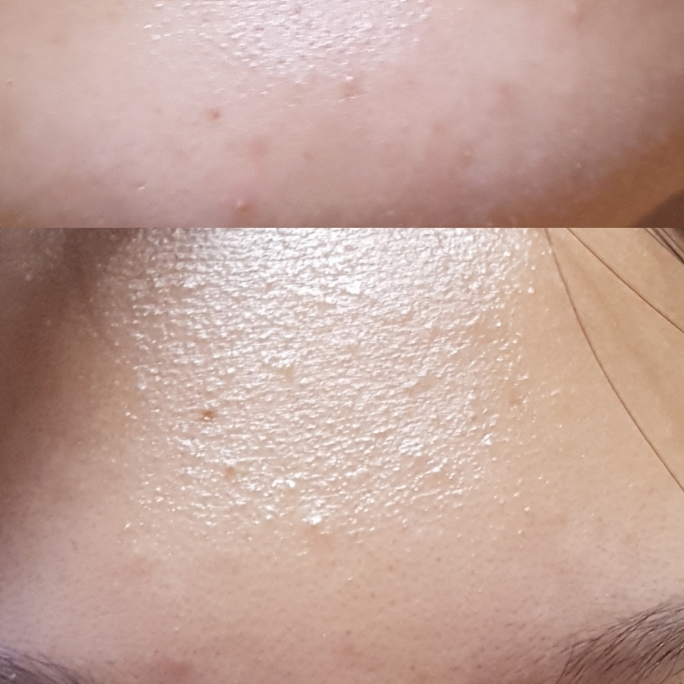 짜잔~ 많이 가라앉았죠!! 저는 제품을 잘 못 써서 나온 여드름은 잘 안 가라앉는 타입이에요! 그래서 이 제품을 한달? 정도 사용했어요! 이 제품은 정말 좁쌉 여드름에 좋은 것같아요! 화농성은 좁쌀보다 좀 더 기다려야되요! 