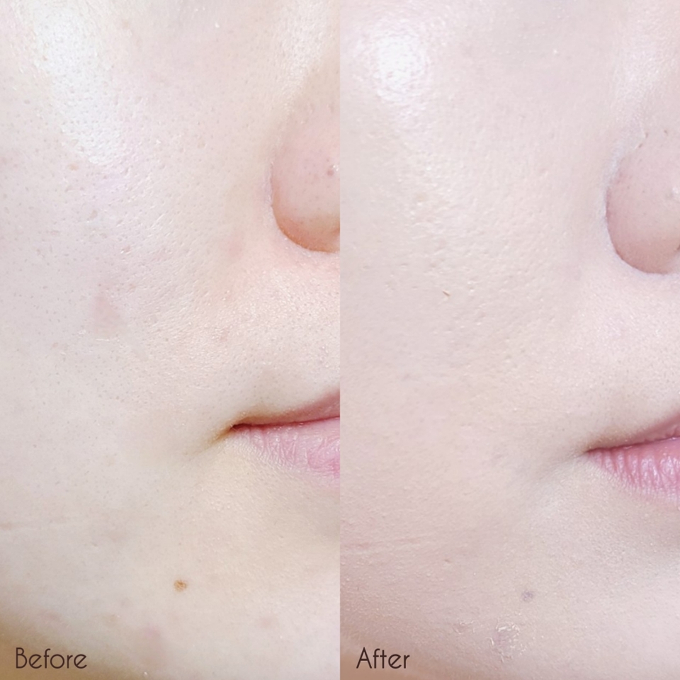 비포 애프터를 보면 모공도 촘촘히 채워졌고, 코 옆 붉은기나 트러블로 인한 얼룩도 깔끔하게 커버됐죠?

특히 눈밑 다크서클 커버용으로는 살몬 컬러인 브라이트가 최고👍👍👍

여러겹 덧바르지 않고도 보색 효과로 말끔히 커버되기 때문에 다크서클커버 컨실러로는 요만한게 없어요😘