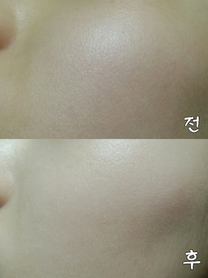 전후사진이에요 같은곳같은조명아래같은카메라를썻구요
딱 보시다시피 피부톤차이도 있고 뜨는감이나 밀리는감이나 그런건없었어요 

지금까지제리뷰였구요
여기서마칠게요 좋아요잊지마시구요

궁금한점은 댓글로달아주세요! 답변해드립니당😁😁

