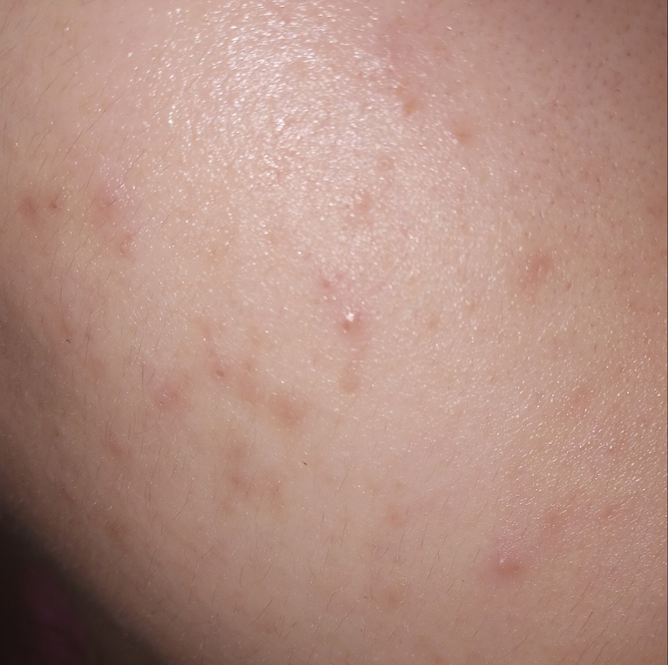 이건 흡수를 다 시킨 상태에요! 주름 개선도 약간 되는 거 같았던 느낌..??ㅋㅋㅋㅋ 보습감 진짜 장난아니에요👍👍 이 마스크팩만 발랐는데 너무 좋은 거 있죠 증말ㅠㅠ 토너 안바르고 이 마스크팩만 사용해주었는데 기초 케어 다 한거 같은 느낌이 들 정도로도 좋더라구요! 개인적으로 끈적이지도않아서 집에 쟁여두고 쓰고 싶은 마스크팩이였어요!