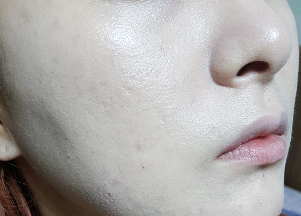 짠지 얼마 되지 않는 흉터 빼고는 이쪽도 나름 괜찮게 커버가 되었어요 그러나 전 이 제품보다 더 커버력이 좋은 쿠션을 써본지라 그리 드라마틱하게 와닿지 않는군요ㅜㅜ 아 마무리는 보송하게 되는 편이라 여름에 쓰기 좋고 밀착력도 괜찮네용