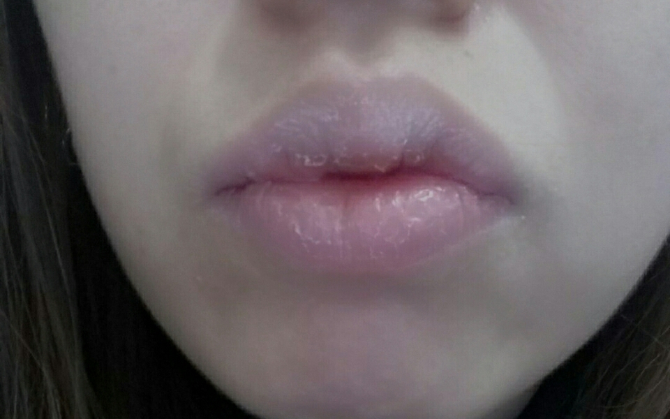 아.... 안쓰러운 제 입술입니다..😢😢
물론 아이소이 립밤 사용전의 모습이예요ㅠ

하얀각질 + 입술 안쪽에 껍질 이며,
아랫입술 가운데는 건조하다 못해 갈라져있었어요...

매일매일 립밤 바르고 잤구요...
하루라도 안바르면 다음날 요런상태였어요