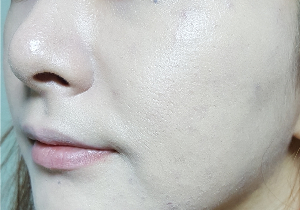 보시면 완벽히 커버가 되진 않았지만 자잘한 흉터들은 나름 잘 커버가 되었어요 그리고 좋은 점은 모공부각이 없다는 점입니당 프라이머 없이 쿠션만 바른 상태인데 쌩얼일 때보다 모공이 덜 부각되죵 바르자마자 찍어서 컬러가 부담스럽게 하얗긴합니다만ㅜ