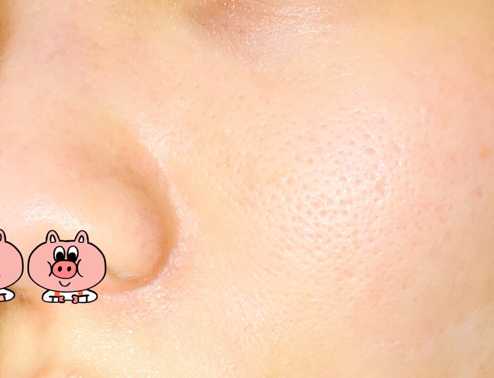 짠!
생생하게 보여드리기위해 망원카메라와 후레쉬까지 히히-
어때요? 모공 속에 피지가 하나도 없죠?
오메 속시원해!!