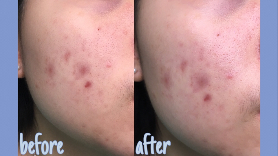 바르기 전과 후 비교사진입니다!
확실히 발랐을때가 은은한 광이 돌게 촉촉한 피부가 되었죠!
위 사진들은 며칠 전 사진인데,

➡️제품을 받고나서 일주일 조금 넘게 사용중인 후기는
요즘 스킨케어에서 달라진 제품이 크림밖에 없는데 
전보다 피부결이 좋아진 느낌이고,
쌩얼일 때도 전보다 피부가 깨끗해 보인다는 이야기를
여러 번 들었답니다😆

더욱 더 꾸준히 사용해서 피부 좋아졌으면 좋겠어요💜