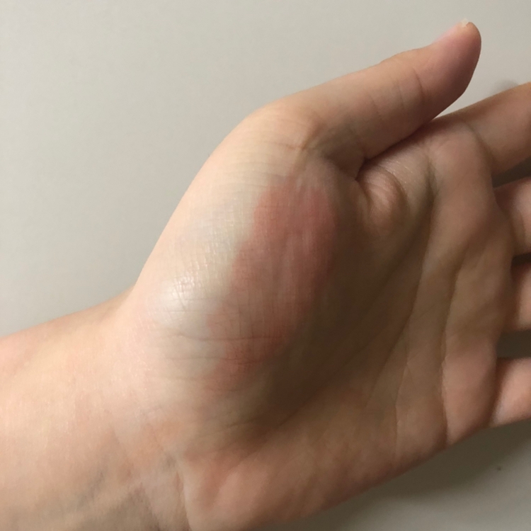 지우면 요렇습니다👆🏻👆🏻👆🏻
착색은 원래색 비슷하게 되는것 같아요!!