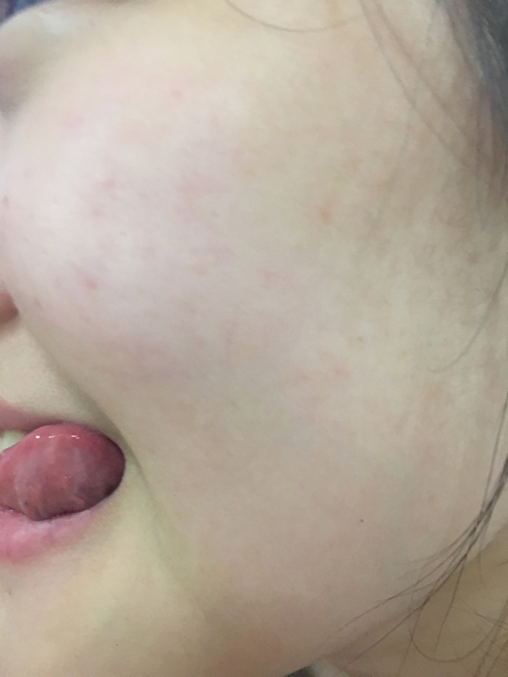 보이시나요? 같은 아이폰 무필터로 촬영했는데 미세하게 피부톤이 밝아졌고, 붉은 반점이나 뾰루지가 올라오지 않았어요ㅠㅠ 이것만으로도 정말 마음에 들었지만 가장 마음에 드는 건 바로 요 #크림21 이 끈적이지 않았다는 거에요!
