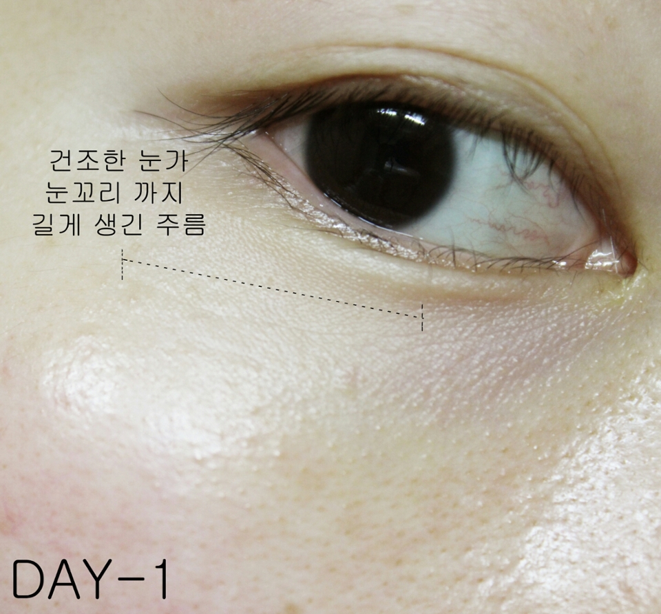 사진을 마음껏 확대해서 보세요. 눈꼬리까지 눈주름이 생겼음을 확인할 수 있어요.(흑) 
그냥 육안으로 보면 심하진 않은데 그냥 가볍게 여기고 넘겼다가는 저 상태에서 더 깊어지는건 시간문제! 이대로는 위험해...! 
