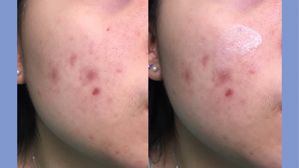 왼쪽이 세안하고 스킨팩만 해준상태인데 
스킨팩 덕분에 갈라지는 곳은 잠재웠지만,
피부 보습까지는 해결되지 못한 상태이고
그 전에는 피부가 땡기고 건조하여 튼 곳이 있었어요!

오른쪽은 크림을 얹어준 모습이에요
캡슐 때문에 처음 발랐을 때는 느낌이 썩 좋지 않다고 
느꼈었는데, 매일 바르다보니 적응도 되었고 
캡슐이 온도에 의해 녹으면서 정말 보습력이 느껴졌어요👍🏻