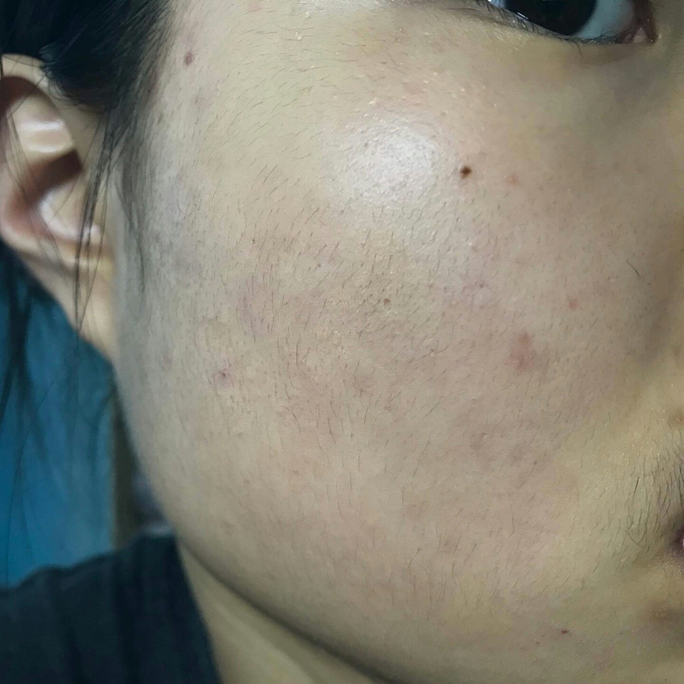 지금 제가 파운데이션 없이 가렸어요 ! 근데 짱이죠 ??? 진짜 좋아요ㅠㅠㅠㅠㅠ이거 손가락으로 조금 묻혀서 톡톡해주고 경계만 없애둔다 생각하면서 발라주시면 진짜 여드름 다 없어지는데 얇아서 너무 돟아요ㅠㅠㅜㅠㅠ진짜 이거 꼭 사세요ㅠㅜㅜㅠㅠㅠㅠㅠ 진짜 너무 좋아서 .. 죄송해요ㅎㅎ

제 리뷰가 유용하셨다면 
좋아요💗 팔로우💗 해주시구 
궁금하신 점 있으시면 아래 댓글 남겨주세요😀