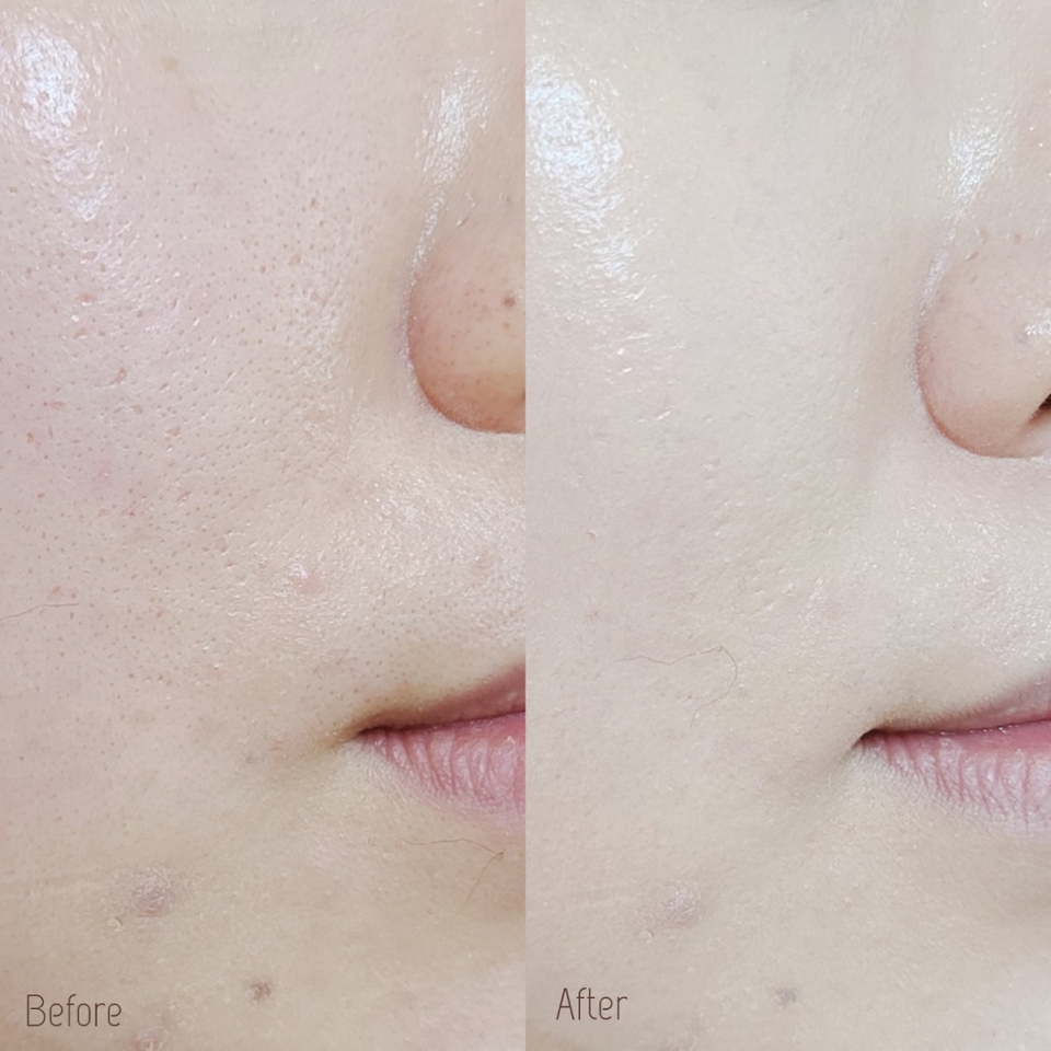 비포 애프터를 보면 붉은기는 정말 깔끔하게 잡혔고, 모공이나 피부 요철도 매끈하게 채워졌죠?

​

개인적으로 가장 만족스러웠던 부분은 섬세하고 부드러운 피부결이 표현된다는 점!

​

아기 피부처럼 야들야들, 보드라우면서도 촉촉한 피부 표현을 할 수 있어서 요즘 베이스는 주구장창 요 아이만 바르고 다니는중😚


