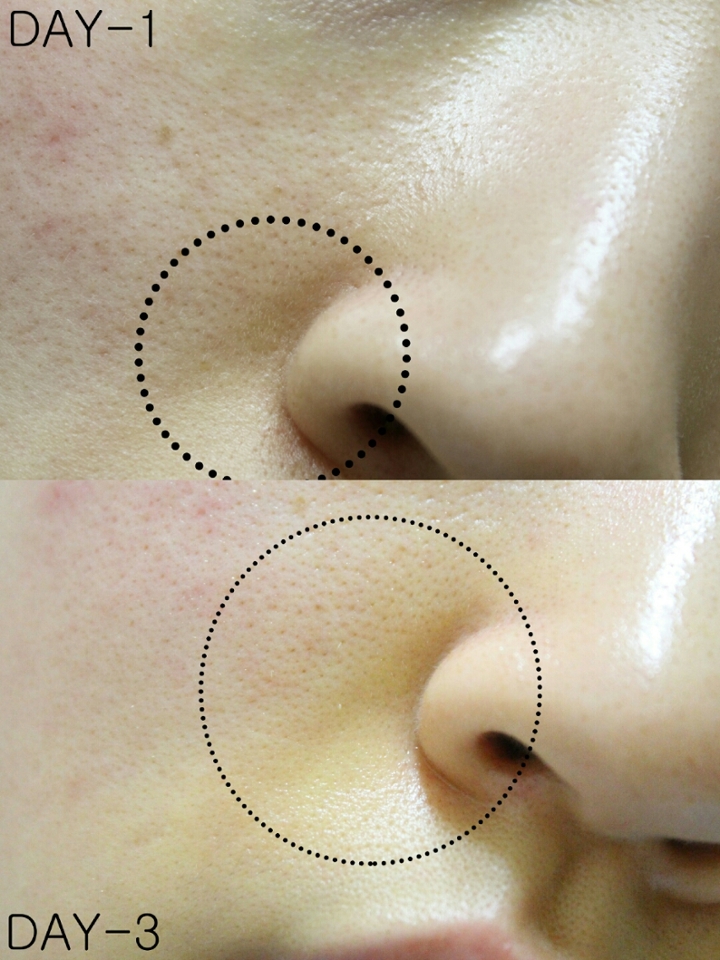 이제 또 다른 저의 고민! 코 옆 꺼짐으로 그늘짐이 있는 부분과 팔자주름 초기단계에 접어든 상태가 어떻게 호전됬나 봐주세요! 3일동안 총 9회 볼륨세럼을 집중적으로 발라주었어요! 
볼륨감이 살아나면서 그늘짐이 많이 옅어지지 않았나요?! 신기방기