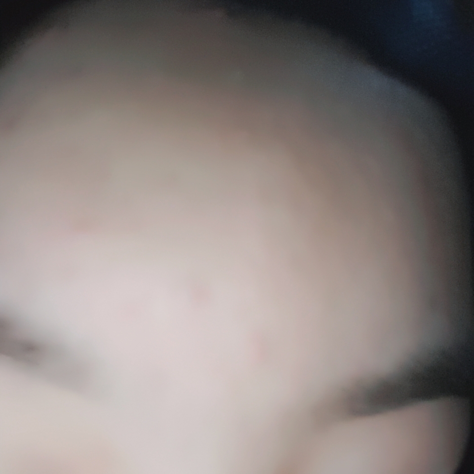 필터 이마 여드름은 그대로 보이네요...