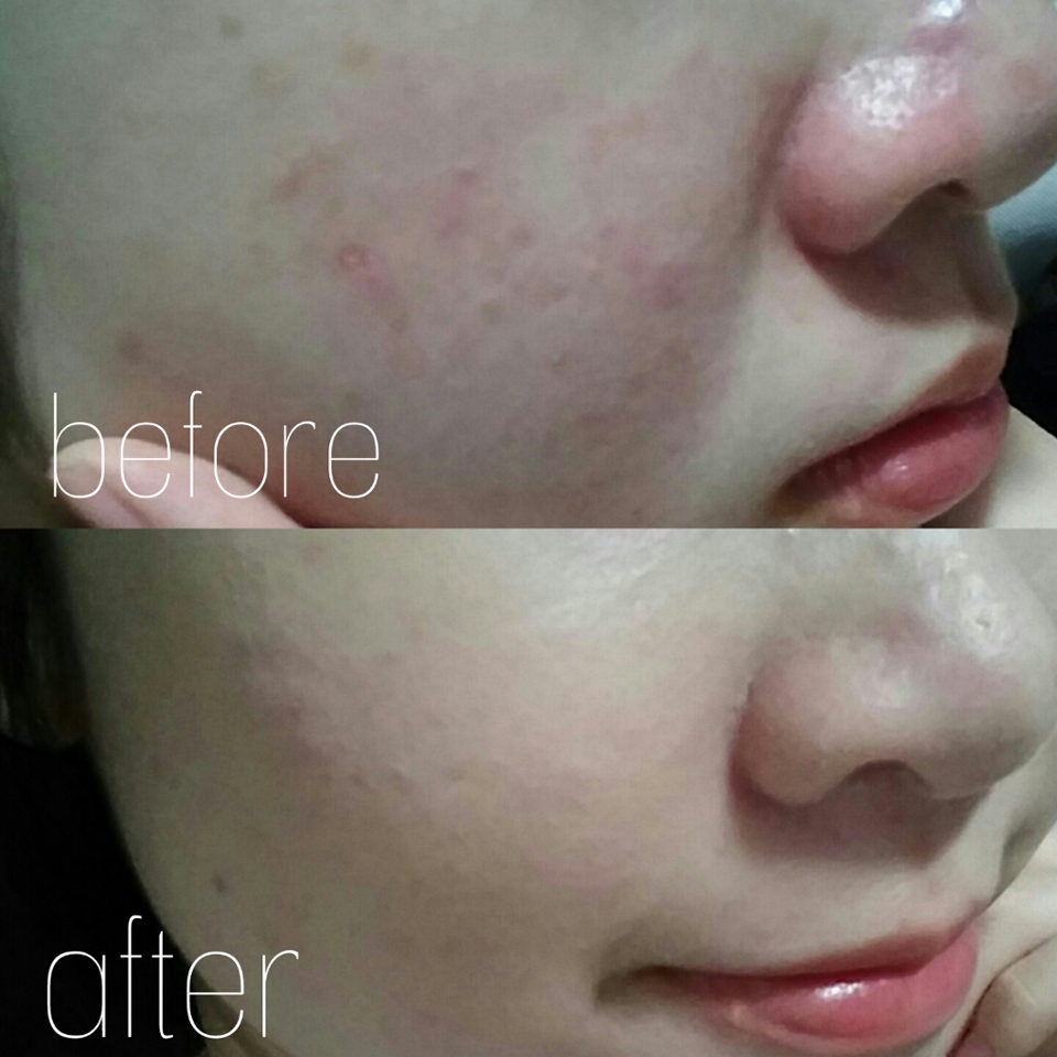 그냥 끝낼순 없겠죠! 이렇게 비교를 해보면 차이가 확실한 것을 알 수 있습니당!😍

이렇게해서 각질은 재우면서 커버는 완벽한 베이스메이크업이 끝이났습니당👊
끝까지 봐주신분들 감사하구 다음엔 더 좋은 리뷰나 뷰티팁으로 돌아오겠습니당😘