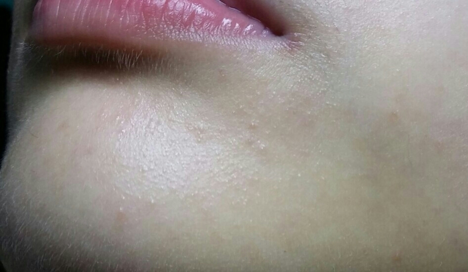 하지만 저렇게 갑자기 난 알레르기(두드러기..?)에는 효과가좋더라구요 저 요즘 저거 진짜 하루에 3번쎅 나는데 저같은 분들 추천합니다! 그럼 읽어주셔서감사합니다 :-)