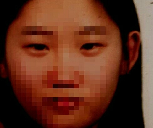 이건중3 얼굴도동그랗고 코도 복코라서ㅜㅜㅜ 얼굴 스트레스가 심해졌어요ㅜㅜ 이때부터 친구권유로 쌍꺼풀만들기를시도해봤어요! 이게 2016년 2월데스