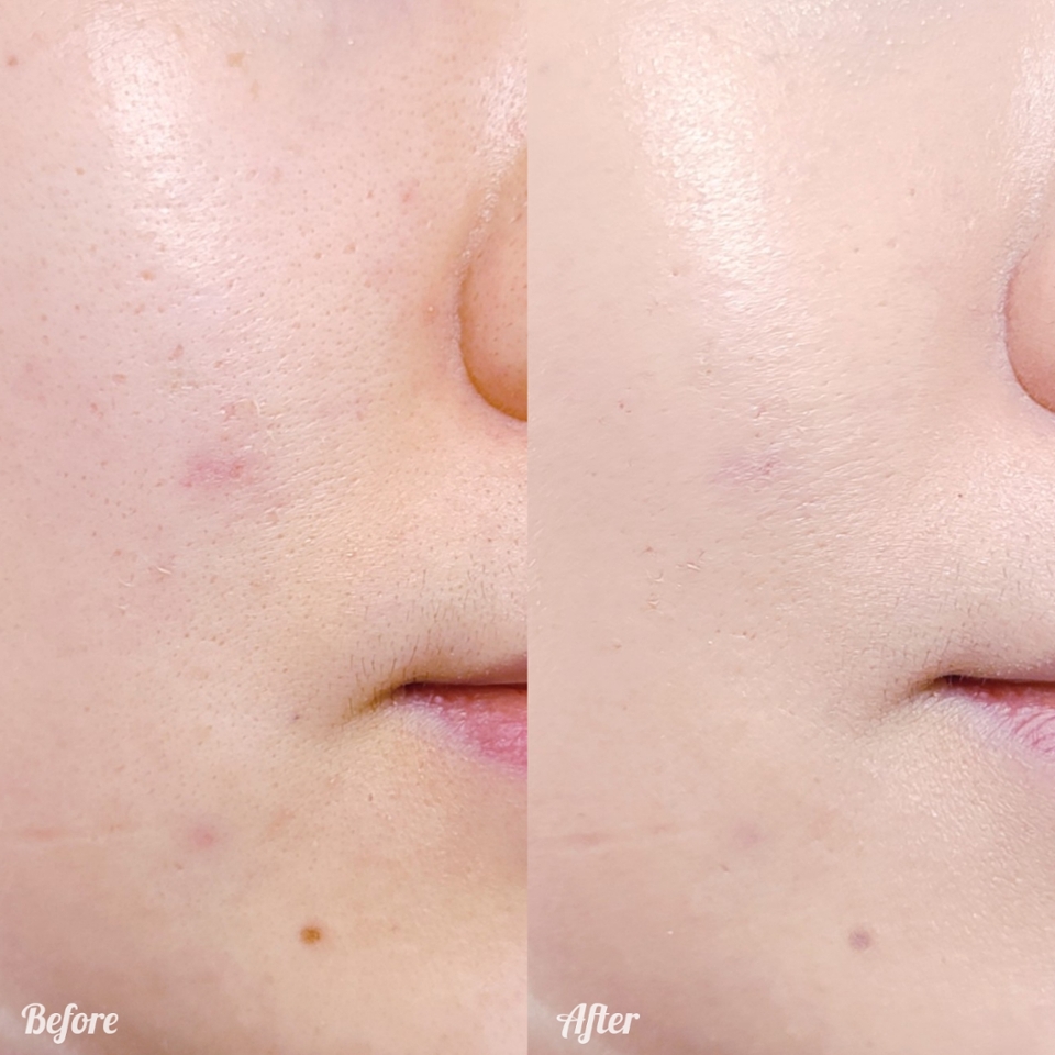 비포 애프터를 보면 트러블 붉은기와 코 옆 칙칙함이 잘 잡혔고, 전반적으로 결이 살아 있는 깔끔한 피부 표현이 눈에 들어오죠?

​

광채도 수분감 머금은 빵반죽 마냥 부드럽고 찬찬하게 올라오는 타입!

​

번들거림과 구분가지 않는 오일광이나 금방 날아가버리는 가벼운 수분광은 no no🙅‍♀️

​

촉촉이 베이스지만 오일리하거나 무거운 타입이 아니라 건성은 물론이고 지복합성 피부까지 부담 없이 사용할 수 있어요

