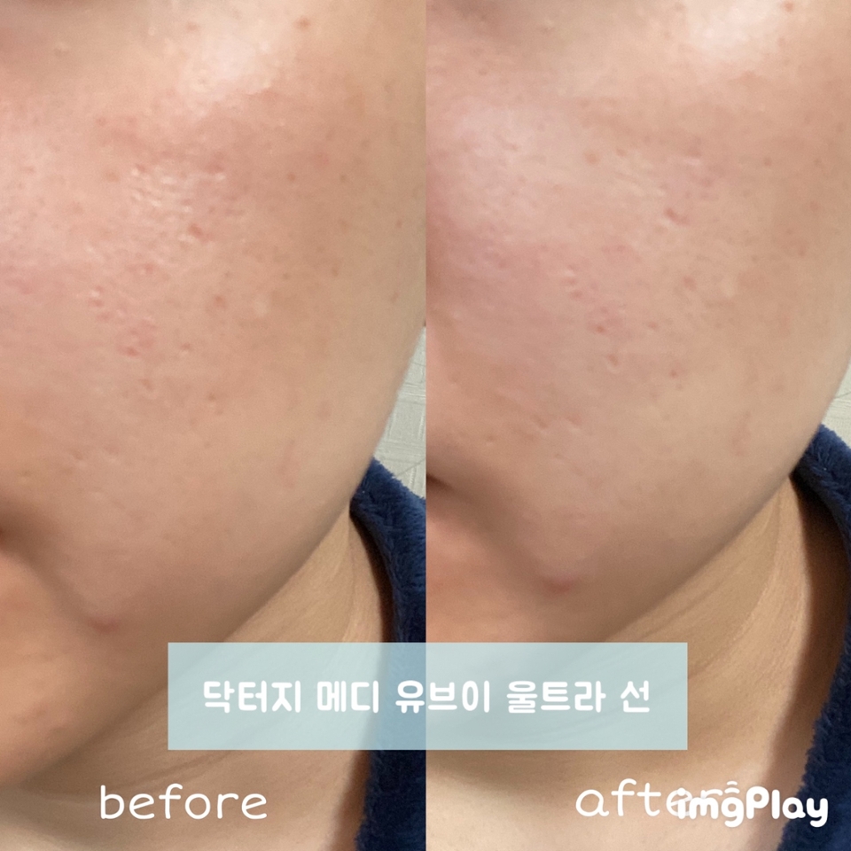 닥터지 메디 유브이 울트라 선 사용 모습입니다

사진을 보시면 아주 약간의 톤 보정이 있는게 느껴지시나요?
이 제품은 약간의 톤 보정이 있는 반면 지속력이 좋지 않고 지성인 제가 사용하면 시간이 지난후 약간의 유분이 올라왔어요(´•̥-•̥` ) 그래서 이 제품은 지성보단 건성분들께 추천드려요!