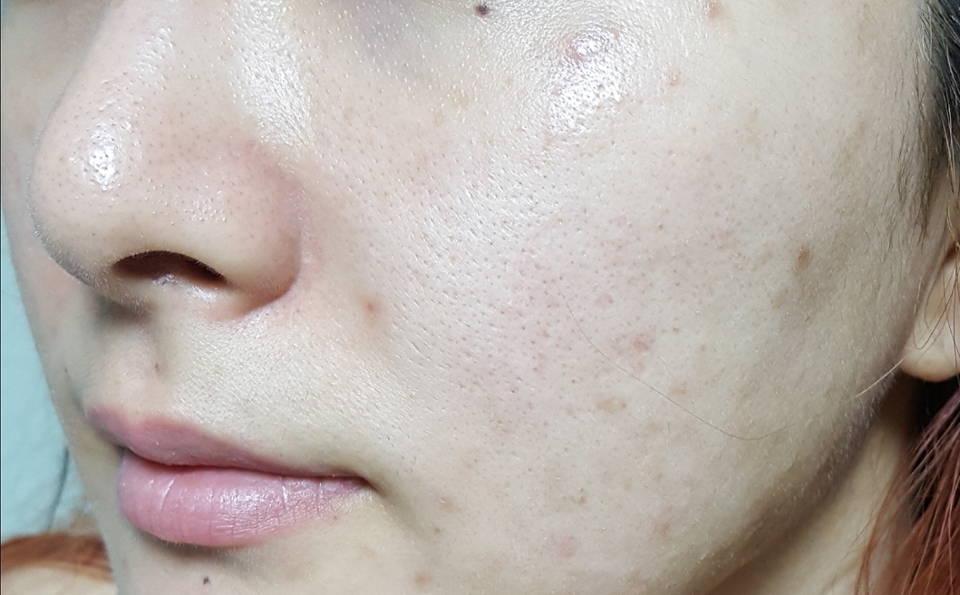 부담스러운 쌩얼을 가져옵니다 모공 요철 흉터 전부 문제인 노답피부ㅜㅜ