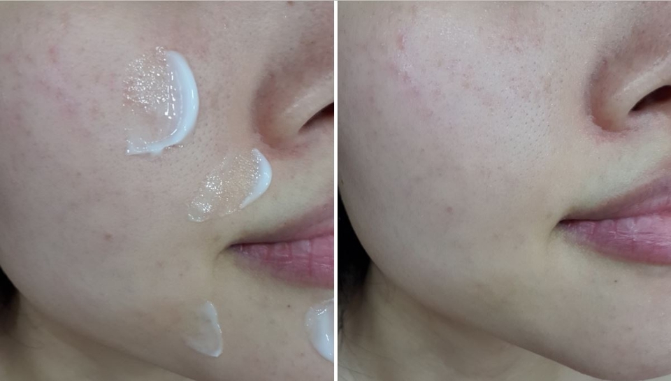 피부상태가 심각했을 때 구매했어요.
지금은 거의 다 나았고 피부상태도 이때보다 훨씬 좋아졌는데
솔직히 셀퓨전씨 수분크림은 민감성피부한테는 추천하고 싶지 않은 크림이에요.

피부에 발랐을 때 자극이 좀 느껴지더라구요. 따가움과는 다른데 간질간질하기도 하고 민감한 부분이 아주약간 마비되는듯한? 뭔가 잘못 바른 것 같은 그런 느낌이 들었어요.
피부염 증상이 살짝 있는 부위에 바르니까 간지러워지고
사용하면서 좁쌀도 조금씩 계속 있어서
반 정도 사용하다가 중단했는데,
피부가 막 나빠진다거나 따끔하게 자극이 심하다거나 그런 수분크림은 아니에요.
쿨링감이 있다는데 저는 쿨링감은 전혀 느끼지 못했고
오히려 바르고 피부가 뭔가에 반응하면서 더 달아오르는 느낌을 좀 받았어요.