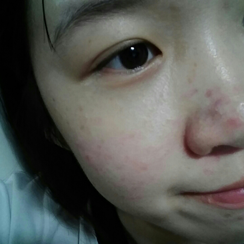 진짜 약간 진장이 된 피부를 확인 할 수 있네용