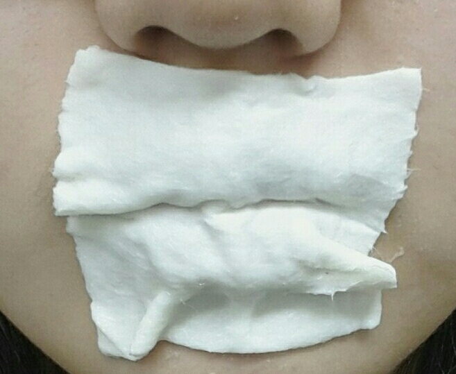 적신 화장솜을 올려주세요~ 그 위에 랩으로 막으셔도되는데 전 어차피 누워있을거라서요ㅎㅎ😆 한 20분? 그정도 올려주신다음 떼주세요!