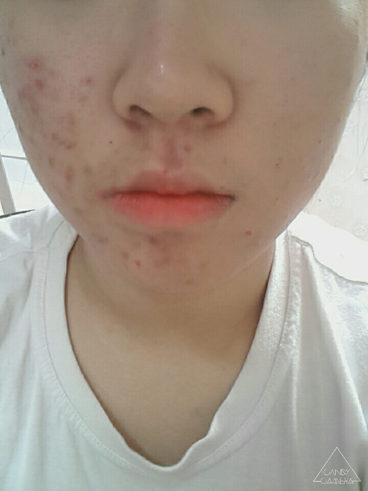 제가 양쪽 볼이랑 턱에 여드름이 좀 많이 심한데 왼쪽이 생얼, 오른쪽이 컨실러 바른쪽입니다 진짜 쩔어요 커버력ㅠ