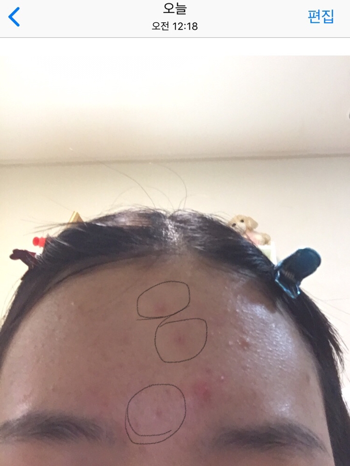 하루후)
하루 뒤에 이마를 봤는데 볼록 튀어나온 여드름은 거의 들어가고 가운데 여드름은 흉터까지 사라지는 거 같아요 
진짜 좋아요