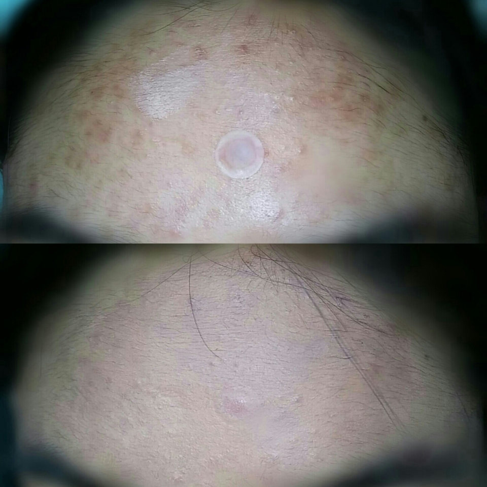 위에가 비포어 아래가 에프터 차이가 심하죠...? 제가 이마가 다른 피부 부위보다 까만 편이라 조금 부자연스러워 보이지만 실제로 보면 커버력이 쨩쨩해요👍👍
사진이 왜이렇게 나왔죠...... 이것보다훨씬 자연스러숩이당...