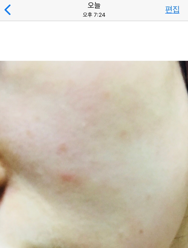 팩은 5-10분 정도만 해주고 스킨케어를 해줬습니당
월화수해서 3일째인데 이 정도로 좋아졌어요☺️

인터넷에서 식염수팩이 피부염에도 효과가 있다고 해서 했는데 완전 만족합니다👍🏻👍🏻🙆🏼