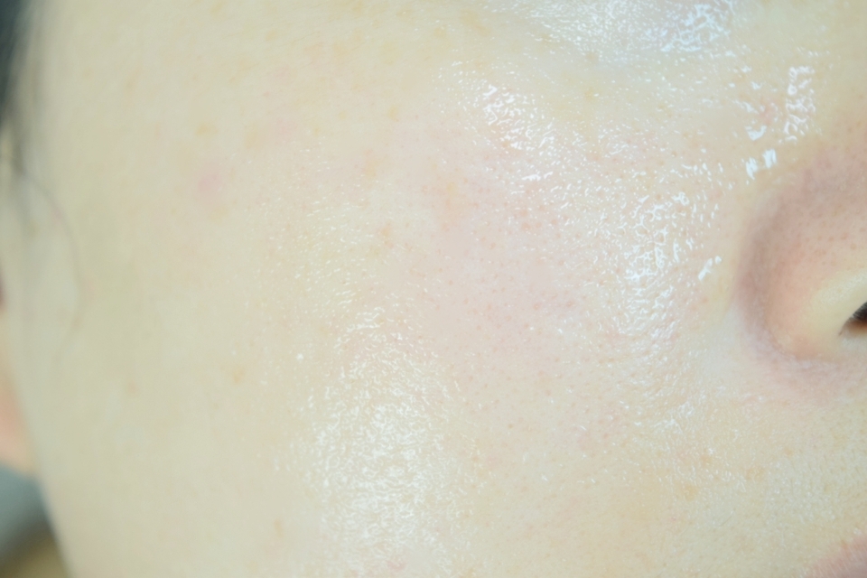 최근 트러블 폭탄 맞은 후로 피부결이 거칠고 모공도 넓어진 상태였는데 물처럼 가볍지만 영양감 있는 보랏빛 앰플을 발라주니 속건조가 잡히는 느낌이 들었어요