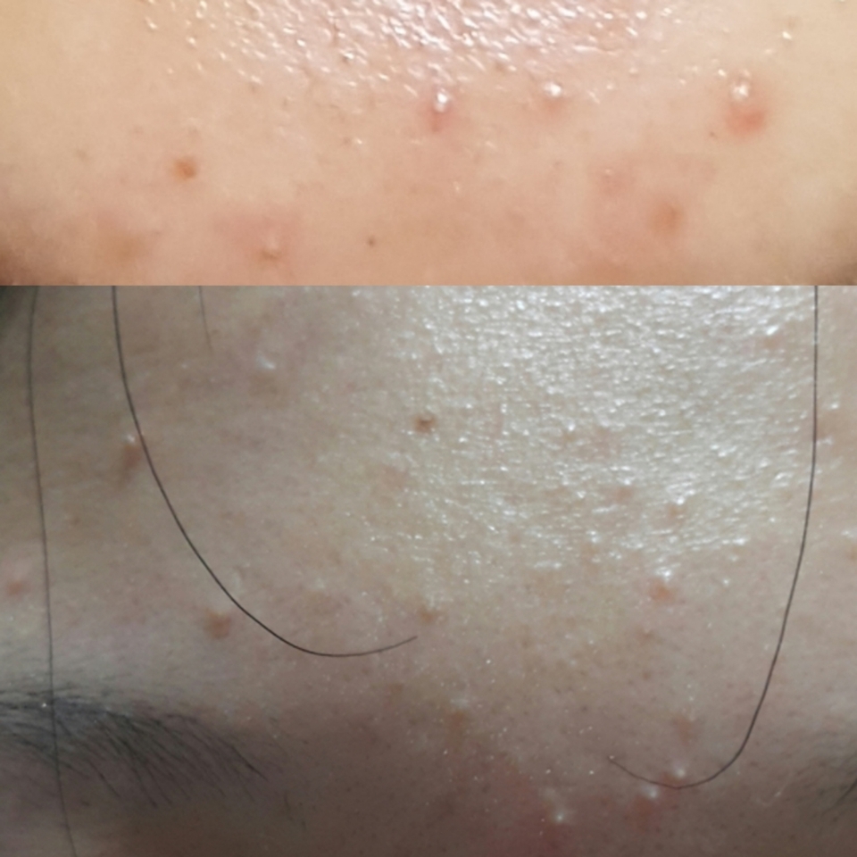 이거 사용하기 전이에요... 제가 이 전날 크림을 새로 바꿨는데 그게 안맞아서 여드름이 올라왔어요 ㅠ 하.지.만. 그 일도 옛날 얘기! 이 제품을 쓰고 어떻게 변했는지 볼까요?