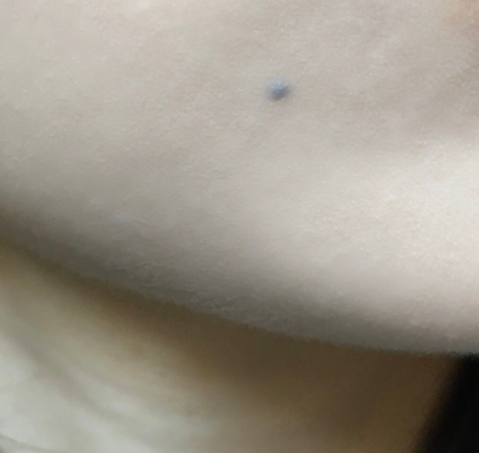 
제가 입 옆에 검은 점이 하나 있는데 이게 이만큼 가려져요!! 이 정도면 매트 쿠션이랑 비슷한 정도의 우수한 커버력이고 잡티나 기미도 반 이상 잘 가려져서 깨끗한 피부표현을 하실 수 있어요. 피부톤도 아주 균일하게 맞춰주고 붉은끼 푸른끼 다 잘 잡아줘요!


