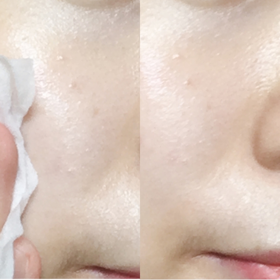 팩하는 절반 이상의 시간은 두드려주고 마지막 1분 정도는 가만히 올려두고 있다가 피부를 전체적으로 한번 닦아내주면서 팩을 떼어내요
(이때도 피부 표면을 가볍게 스친다는 정도로 닦아줘야돼요! 안그러면 이마저도 자극으로 이어질 수 있으니까요...★)