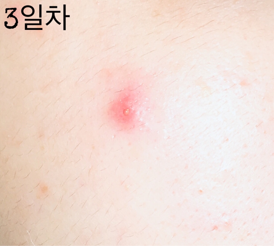 3일차! 

전날보다 많이 호전되었죠

패치를 붙인 상태에서 클렌징을 하면 테두리 부분이 살짝 들뜨기는 하지만 방수 기능으로 상처부위가 물에 닿지 않아요