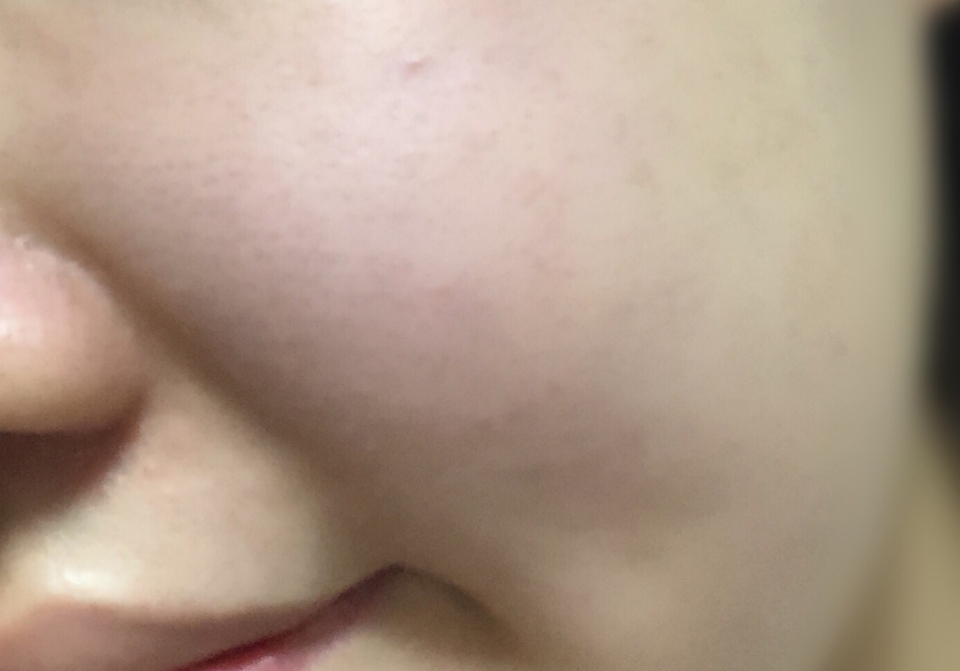 피부에도 닦아내듯이 발라주었는데, 따갑거나 하지 않아서 좋았지만 수분감이 느껴지는 건 미미했어요 ㅠㅠ