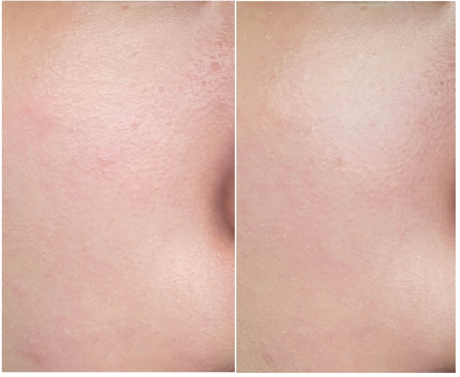 붉은기와 약간의 트러블이 잡힌게 보이시나요??
컨실러는 얇게 두세번 정도만 발라주시면 될 것 같아요!