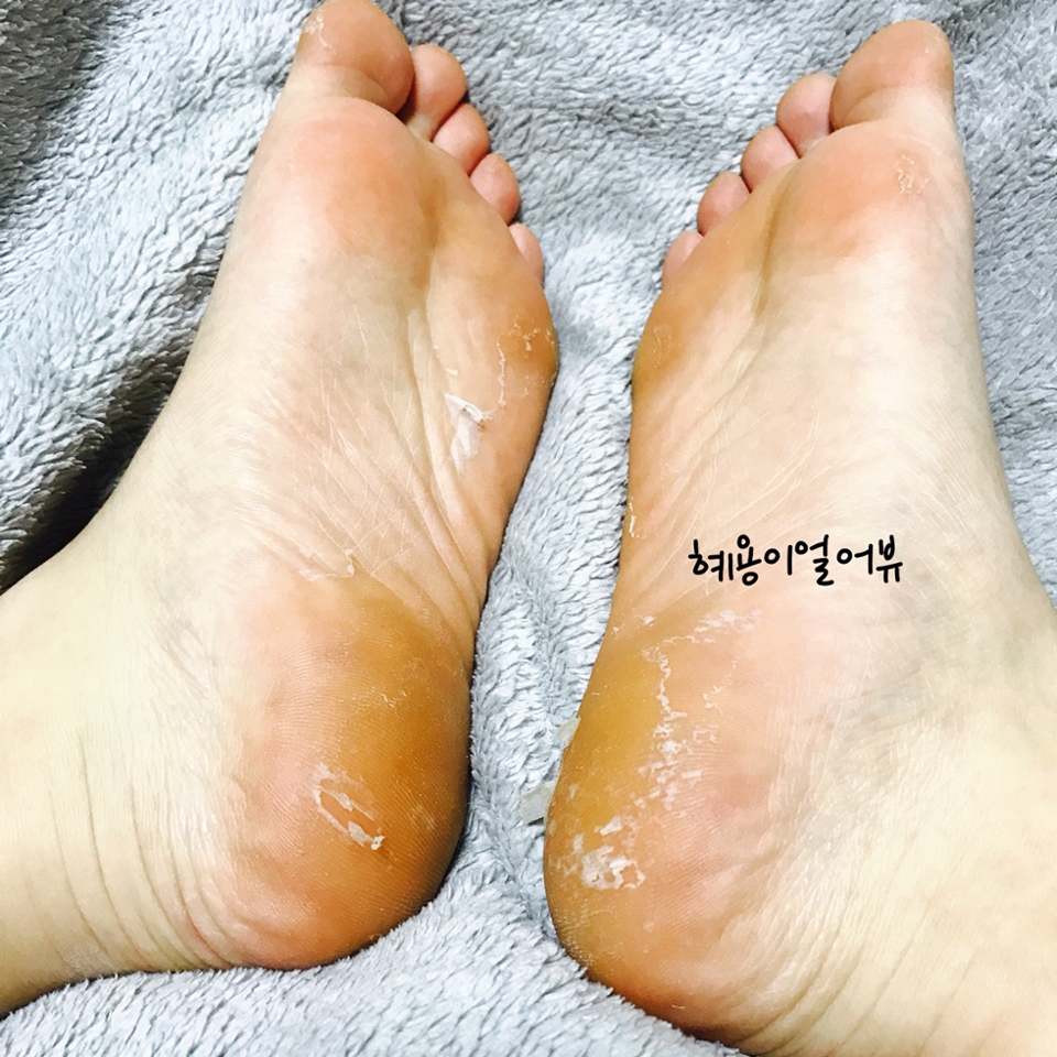 3일차.. 잊고살았던 각질양말팩 이떠올른 후 바로 찍은 사진입니다!
이 발이 주범이었는데.. 이상한데서 고민하고 청소를하고있었다니..... (나란년)

밑에 나올 사진은 극혐 중에서도 개극혐주의 니, 심신이 약하신분들은 보지마세오..ㅠ_ㅠ
