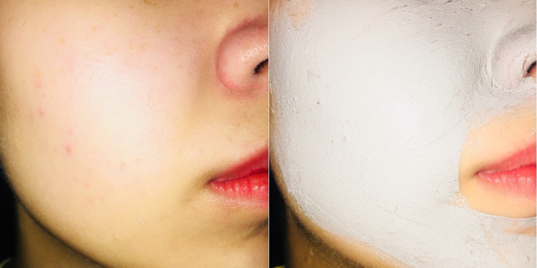 팩하기전 제 피부은 볼쪽이랑 코옆에 피지가 많고 모공이 넓어져있는 피부예요! 팩을 눈가와 입가를 제외한 얼굴에 펴발라주고 10분뒤에 미온수로 씻어냈어요!
쿨링효과가 있는 제품이여서 그런지 피부에 올리자마자 싸한 느낌이 들면서 시원하더라구요!