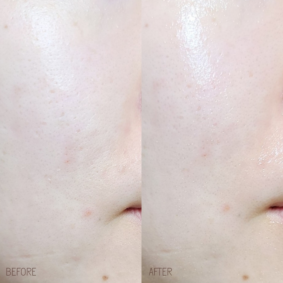 세라베리옴 앰플 크림 비포 애프터를 봐도 피부 윤기와 수분감이 채워져 밀도 있는 광채가 올라오지만, 과한 번들거림이나 끈적임은 놉!🙅‍♀️

​

데일리&얼리 안티에이징이라는 목적에 꼭 부합하게 가볍고, 촉촉하고, 순한 제품이라고 생각해 주시면 될 거 같아요

